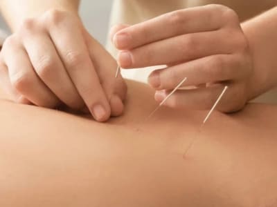 Acupuntura em Mogi das Cruzes